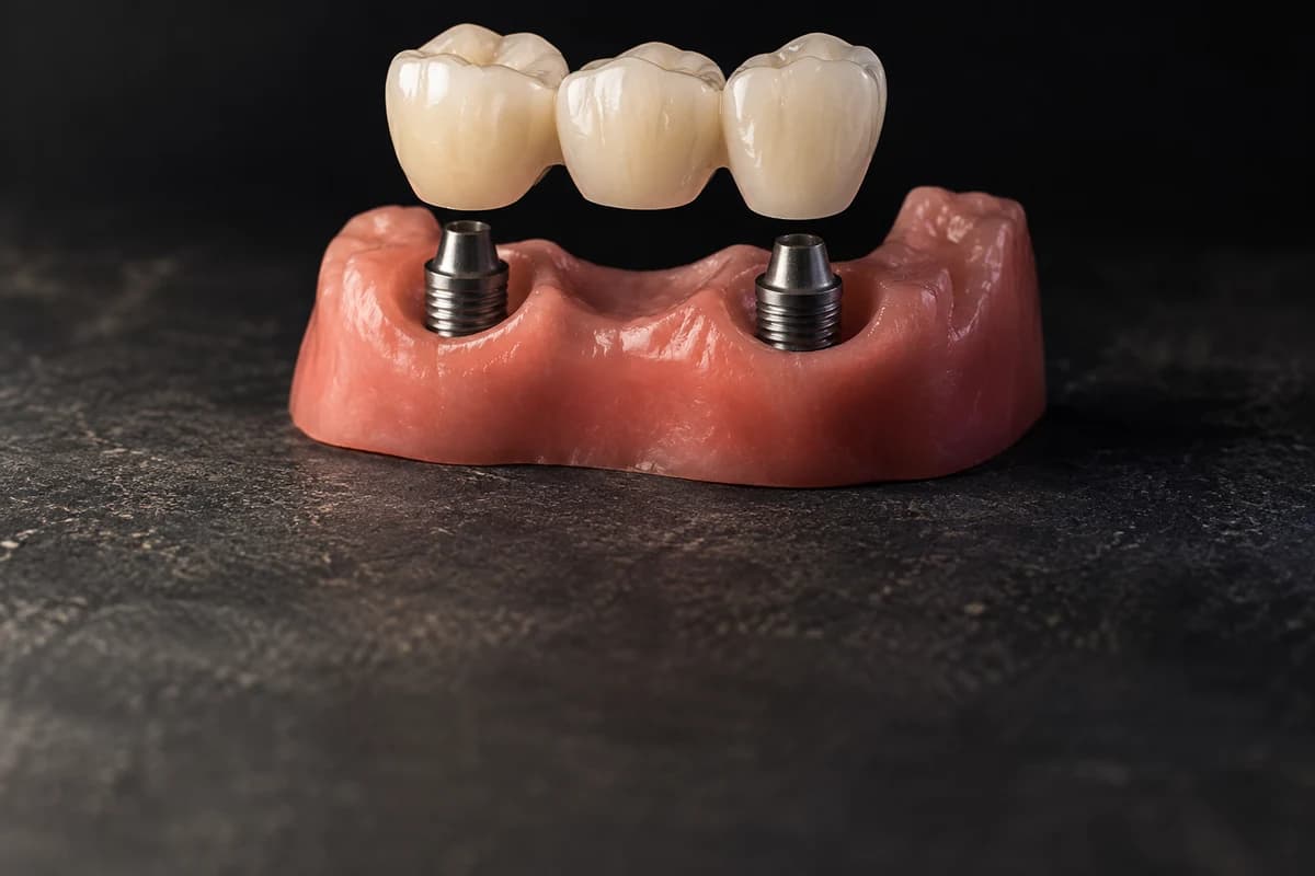 Implant-supported teeth